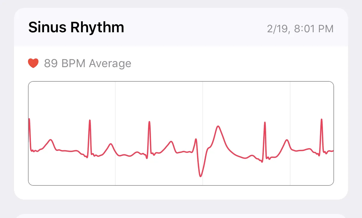 Her ECG from my Apple Watch