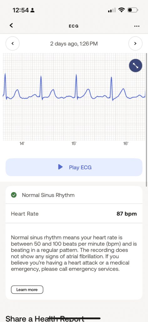 Withings ScanWatch Vitals: A Potential Competitor to the Apple Watch 8 An ECG taken by a Withings ScanWatch Vitals